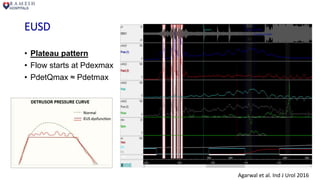 EUSD
• Plateau pattern
• Flow starts at Pdexmax
• PdetQmax ≈ Pdetmax
Agarwal et al. Ind J Urol 2016
 