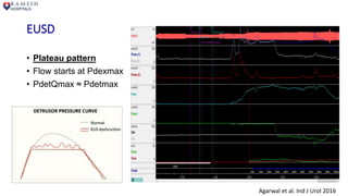 EUSD
• Plateau pattern
• Flow starts at Pdexmax
• PdetQmax ≈ Pdetmax
Agarwal et al. Ind J Urol 2016
 