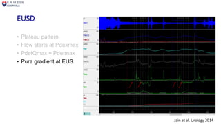 EUSD
• Plateau pattern
• Flow starts at Pdexmax
• PdetQmax ≈ Pdetmax
• Pura gradient at EUS
Jain et al. Urology 2014
 