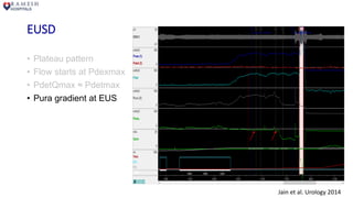 EUSD
• Plateau pattern
• Flow starts at Pdexmax
• PdetQmax ≈ Pdetmax
• Pura gradient at EUS
Jain et al. Urology 2014
 