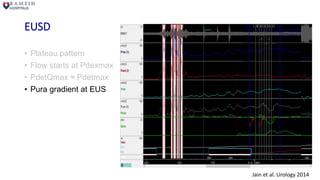 EUSD
• Plateau pattern
• Flow starts at Pdexmax
• PdetQmax ≈ Pdetmax
• Pura gradient at EUS
Jain et al. Urology 2014
 