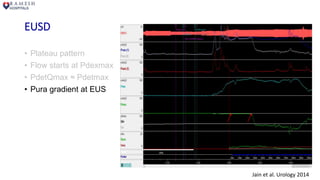 EUSD
• Plateau pattern
• Flow starts at Pdexmax
• PdetQmax ≈ Pdetmax
• Pura gradient at EUS
Jain et al. Urology 2014
 