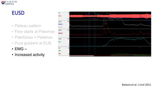 EUSD
• Plateau pattern
• Flow starts at Pdexmax
• PdetQmax ≈ Pdetmax
• Pura gradient at EUS
• EMG –
• Increased activity
Batavia et al. J Urol 2011
 