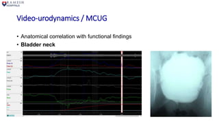 Video-urodynamics / MCUG
• Anatomical correlation with functional findings
• Bladder neck
 
