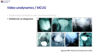 Video-urodynamics / MCUG
• Anatomical correlation with functional findings
• Additional co-diagnosis
Agarwal MM. Manual of Urodynamics 2014
 