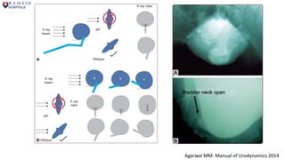 Agarwal MM. Manual of Urodynamics 2014
 