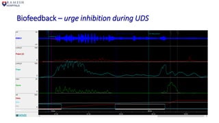 Biofeedback – urge inhibition during UDS
 