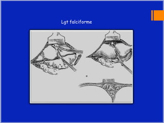 Mobilisation hépatique : incision du
ligament triangulaire droit et du
coronaire droit jusqu’au bord droit de
VCI
Lgt tria...