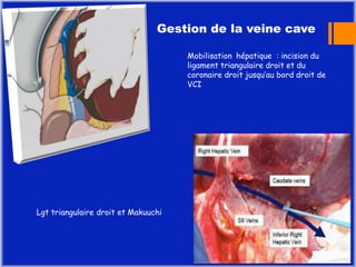 voies d 'abord du kyste hydatique du foie | PPTX