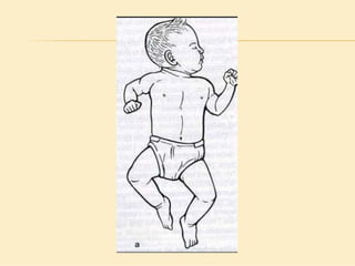 Método o Terapia Vojta