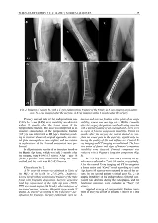 SCIENCES OF EUROPE # 11 (11), 2017 | MEDICAL SCIENCES 75
Fig. 2. Imaging of patient M. with a C-type periprosthetic fracture of the femur: а) X-ray imaging upon admis-
sion; b) X-ray imaging after the surgery; c) X-ray imaging within 3 months after the surgery.
Primary survival rate of the endoprosthesis was
95.6%. In 1 case (4.4%) stem instability was detected
within 10 months after the femur union of the
periprosthetic fracture. This case was interpreted as an
incorrect classification of the periprosthetic fracture
(B2 type was interpreted as B1 type), therefore result-
ing in incorrect choice of surgical approach - an inter-
nal plate osteosynthesis was applied, and no revision
or replacement of the femoral component was per-
formed.
In all patients the results of an interview based on
the Harris Hip Score, which was held 3 months after
the surgery, were 64.9±16.7 scores. After 1 year 16
(69.9%) patients were interviewed using the same
method, and the result was 86.5±15.9 scores.
Clinical case No. 2.
A 79- year-old woman was admitted at Clinic of
the MTO of the MMA on 27.07.2014. Diagnosis:
Closed periprosthetic comminuted fracture of the right
femur with fragments disposition. Surgery: cemented
total hip replacement of the right hip joint (2003).
IHD, exertional angina (III Grade), atherosclerosis of
aorta and coronary arteries, idiopathic hypertensia (II
grade). B1 fracture according to the Vancouver Clas-
sification for fractures. Surgery performed: open re-
duction and internal fixation with a plate of an angle
stability, screws and cerclage wires. Within 3 months
after the surgery the patient could walk using crutches
with a partial loading of an operated limb, there were
no signs of femoral component instability. Within ten
months after the surgery the patient started to com-
plain on severe pain in the right hip, significantly re-
ducing the quality of life and self-service. Control X-
ray imaging and CT imaging were obtained. The frac-
ture union of femur and signs of femoral component
instability were detected. Femoral component was
replaced with a Wagner’s long-stem component (Fig.
3).
In 2 (8.7%) cases (1 man and 1 woman) the re-
sults were evaluated at 7 and 10 months, respectively.
After the control X-ray imaging and CT investigation
a femur union and “Good” result according to Harris
Hip Score (83 scores) were reported in one of the pa-
tient. In the second patient (clinical case No. 2) an
aseptic instability of the endoprosthesis femoral com-
ponent was detected during the radiography, and the
functional outcomes were evaluated as “Poor” (67
scores).
Applied strategy of periprosthetic fracture treat-
ment in analyzed cohort of patients is shown in Table
3.
 