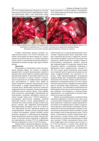 40 Sciences of Europe # 50, (2020)
и 87,7%. Главной проблемой у пациентов с негатив-
ными результатами являлось формирование стрик-
тур мочеточника либо в зоне анастомоза между
лоскутом мочевого пузыря и мочеточником, либо
выше анастомоза, что было связано с неадекватно-
стью макроскопической оценки жизнеспособности
мочеточника (Рис 2).
Рис 2. Интраоперационные фото демонстрируют некротические изменения средней трети правого мо-
четочника на протяжении 2,5 см через 2 месяца после первичной операции Боари.
Пузырный лоскут имеет хорошее кровоснабжение, внешне не изменен.
Стойкое уменьшение емкости мочевого пу-
зыря отмечено лишь у 3 из 73 (4,1%) больных, но с
нашей точки зрения оно было связано не с выпол-
нением лоскутной пластики, а с лучевой терапией в
одном случае и длительными воспалительными из-
менениями в мочевом пузыре в двух других наблю-
дениях.
Дискуссия.
Основываясь на имеющемся опыте использо-
вания операции Боари, мы считаем ее наиболее
приоритетной техникой реконструкции нижней и
средней трети мочеточника в ситуации ятрогенной
уретеральной травмы. В настоящее время мы пол-
ностью отказались от снятия лигатур с мочеточ-
ника и выделения его из инфильтратов или рубцо-
вых конгломератов. С нашей точки зрения не
нужно стремиться сохранить максимальную длину
мочеточника в ущерб кровоснабжению его ди-
стальной части. Необходимо полностью заместить
поврежденный или имеющий сомнительное крово-
снабжение участок данного органа. Этим требова-
ниям полностью удовлетворяет уретеральная ре-
конструкция с помощью тубулярного лоскута мо-
чевого пузыря. Среди всех 7 (9,6%) пациентов с
негативными результатами операции основной
проблемой явилось плохое кровоснабжение ди-
стальной части мочеточника, которое не было кор-
ректно оценено при первичной реконструкции.
Непосредственно пузырный лоскут ни в одном из
этих наблюдений не имел признаков некроза или
склерозирования. Уровень успеха операции Боари
в нашем исследовании, которое большей частью
включало пациентов с необходимостью формиро-
вания протяженных лоскутов на фоне тяжелых руб-
цовых и воспалительных изменений в забрюшин-
ном пространстве, составил 97,3%. К нефрэктомии
пришлось прибегнуть только в 2 (2,3%) случаях.
Данная работа продемонстрировала высокую
эффективность использования тубуляризованного
лоскута мочевого пузыря даже при выполнении
субтотальной или тотальной реконструкции моче-
точника. Сравнительный анализ представил сход-
ные отдаленные результаты у пациентов с различ-
ной длиной пузырных лоскутов. В последние годы
отмечается значительный рост интереса именно к
использованию максимально длинных лоскутов
при операции Боари. В литературе имеются лишь
единичные работы и клинические сообщения о
применении такого хирургического подхода [11-
16]. Хотя третья группа (замещение мочеточника
до его верхней трети) в данном исследовании не яв-
лялась репрезентативной, мы выделили ее от-
дельно, чтобы продемонстрировать возможности
операции Боари при "экстремально протяженном"
замещении мочеточника. Оценка уровня интраопе-
рационных осложнений показала, что они в основ-
ном были представлены геморрагическими пробле-
мами и достоверно чаще встречались у пациентов
третьей группы. Это объясняется необходимостью
мобилизации почки и всего мочеточника из массив-
ных рубцовых конгломератов и воспалительных
инфильтратов, что сопровождается высокой веро-
ятностью сосудистой травмы.
Ранние послеоперационные осложнения были
одинаково выражены у пациентов всех трех групп
за исключением дизурического синдрома, который
чаще выявлялся у пациентов с реконструкцией мо-
четочника до его верхней трети. Однако эти разли-
чия не являлись статистически значимыми. Мы свя-
зываем более частое возникновение дизурии со зна-
чительным уменьшением объема мочевого пузыря
при создании лоскута максимальной длины. Тем не
менее, в большинстве случаев дизурические явле-
ния исчезали в течение недели после операции, а
объем мочевого пузыря восстанавливался в течение
двух месяцев. Стойкое уменьшение объема моче-
вого пузыря через один год имело место только у 3
из 73 (4,1%) больных. С нашей точки зрения оно
было связано не с выполнением лоскутной пла-
стики, а с лучевой терапией и с уже имевшимися
 