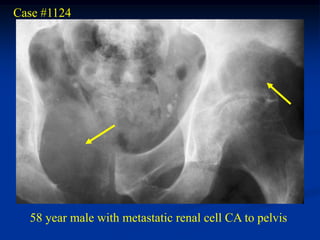 Case #1124




  58 year male with metastatic renal cell CA to pelvis
 