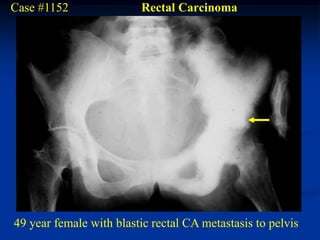 Case #1152               Rectal Carcinoma




49 year female with blastic rectal CA metastasis to pelvis
 