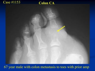 Case #1153             Colon CA




67 year male with colon metastasis to toes with prior amp
 