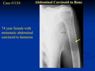 Case #1154            Abdominal Carcinoid to Bone




74 year female with
metastatic abdominal
carcinoid to humerus
 