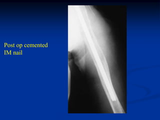 Post op cemented
IM nail
 