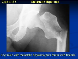 Case #1155              Metastatic Hepatoma




62yr male with metastatic hepatoma prox femur with fracture
 