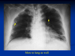 Mets to lung as well
 