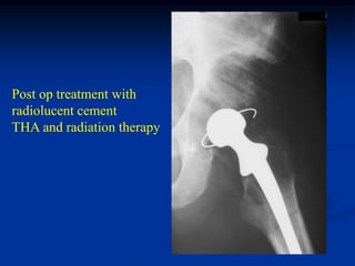 Post op treatment with
radiolucent cement
THA and radiation therapy
 