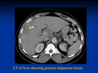 CT of liver showing primary hepatoma lesion
 