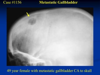 Case #1156           Metastatic Gallbladder




 49 year female with metastatic gallbladder CA to skull
 