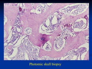 Photomic skull biopsy
 