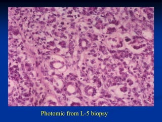 Photomic from L-5 biopsy
 
