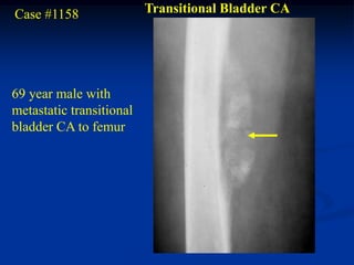 Case #1158                Transitional Bladder CA




69 year male with
metastatic transitional
bladder CA to femur
 