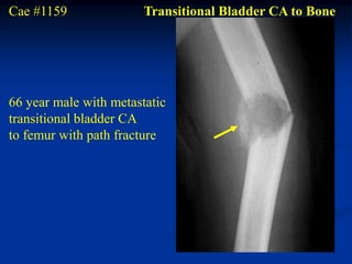 Cae #1159               Transitional Bladder CA to Bone




66 year male with metastatic
transitional bladder CA
to femur with path fracture
 