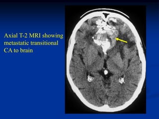 Axial T-2 MRI showing
metastatic transitional
CA to brain
 