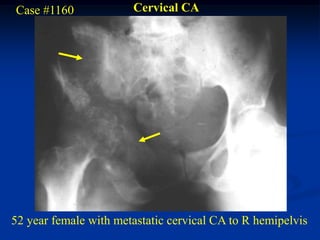 Case #1160             Cervical CA




52 year female with metastatic cervical CA to R hemipelvis
 