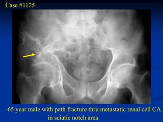 Case #1125




65 year male with path fracture thru metastatic renal cell CA
               in sciatic notch area
 