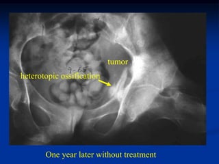 tumor
heterotopic ossification




       One year later without treatment
 