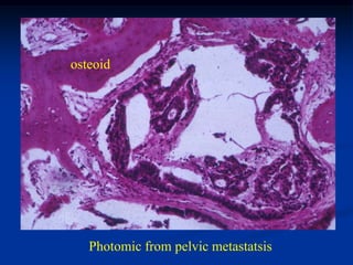 osteoid




   Photomic from pelvic metastatsis
 