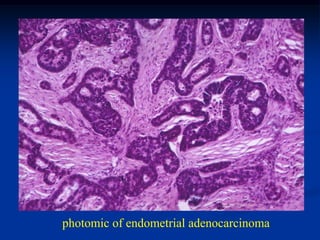 photomic of endometrial adenocarcinoma
 