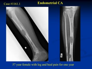Case #1161.1              Endometrial CA




      57 year female with leg and heal pain for one year
 
