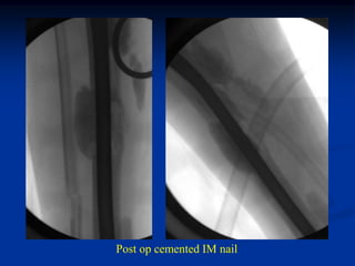 Post op cemented IM nail
 