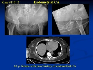 Case #1161.2           Endometrial CA




        63 yr female with prior history of endometrial CA
 