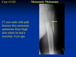 Case #1162                 Metastatic Melenoma




27 year male with path
fracture thru metastatic
melanoma from thigh
skin where he had a
resection 4 yrs ago
 