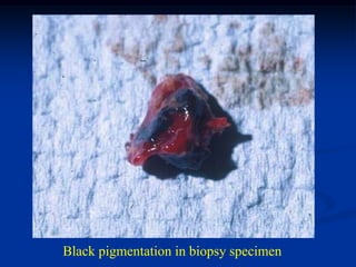 Black pigmentation in biopsy specimen
 