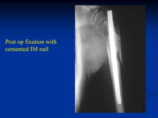Post op fixation with
cemented IM nail
 