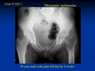 Case #1162.1
                             Metastatic melanoma




          29 year male with pain left hip for 6 weeks
 