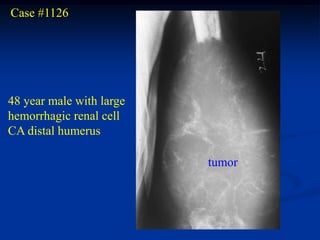 Case #1126




48 year male with large
hemorrhagic renal cell
CA distal humerus

                          tumor
 