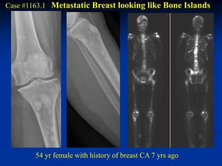 Case #1163.1 Metastatic Breast looking like Bone Islands




        54 yr female with history of breast CA 7 yrs ago
 