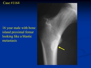 Case #1164




16 year male with bone
island proximal femur
looking like a blastic
metastasis
 