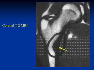 Coronal T-2 MRI
 