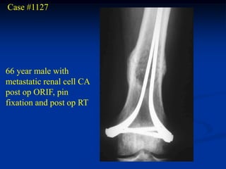 Case #1127




66 year male with
metastatic renal cell CA
post op ORIF, pin
fixation and post op RT
 
