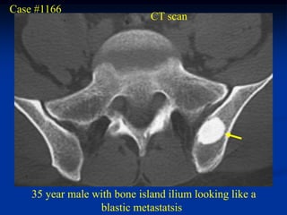 Case #1166
                              CT scan




    35 year male with bone island ilium looking like a
                  blastic metastatsis
 