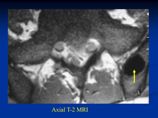 Axial T-2 MRI
 